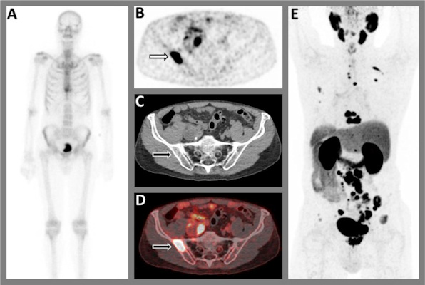 A 75 year old patient with biopsy proven prostate cancer