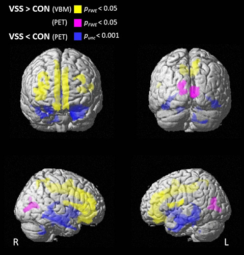 Differences in brain gray matter volume, voxel-based morphometry (VBM), and glucose metabolism (PET) between patients with visual snow syndrome (VSS) and controls