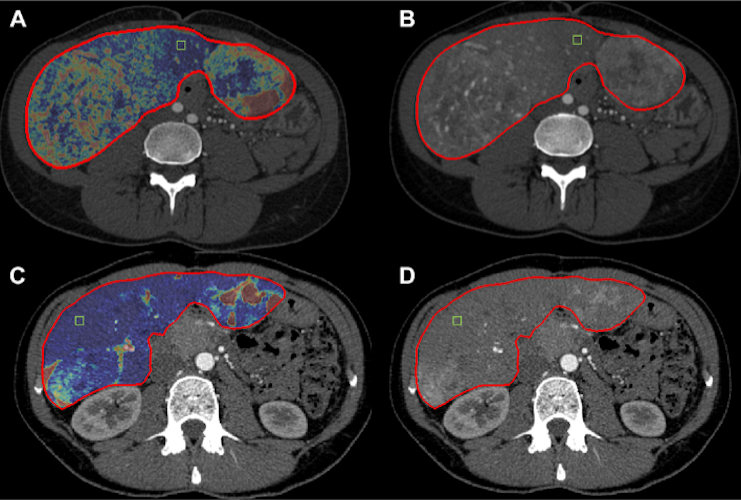 Changes in liver-enhancing tumor burden (LETB) in a 36-year-old woman with pancreatic neuroendocrine liver metastases treated with transarterial chemoembolization. (A, B) Pretreatment CT showed a total hepatic volume of 2823 cm3, a volume of enhancing tumor of 1035 cm3, and a LETB of 36.6%. (C, D) Post-treatment CT showed a total hepatic volume of 1607 cm3, a volume of enhancing tumor of 354 cm3, and an LETB of 22%. LETB dropped by 41%. Hepatic and whole-body progression-free survivals were each 11 months, and overall survival was 21 months. Note: The segmentation mask to determine the whole-liver volume is shown as the red borders of the liver. The green box represents the 0.5 cm3 region of interest placed in the nontumoral liver parenchyma to quantify the LETB