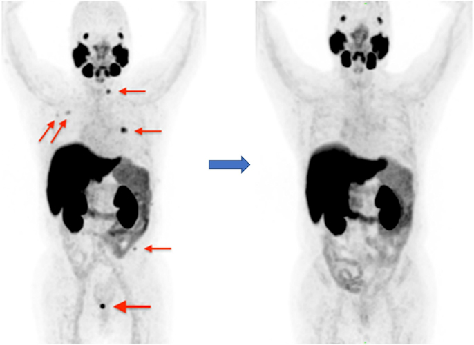  maximum intensity projection image showing the presence of anomalous F-18 PSMA-1007 concentration in the pelvic cavity, suggesting local recurrence of prostate cancer (left, thick arrow), local bones metastasis on pretreatment examination (left, thin arrows), and their absence on post-treatment (S-RT and ADT) examination (right)
