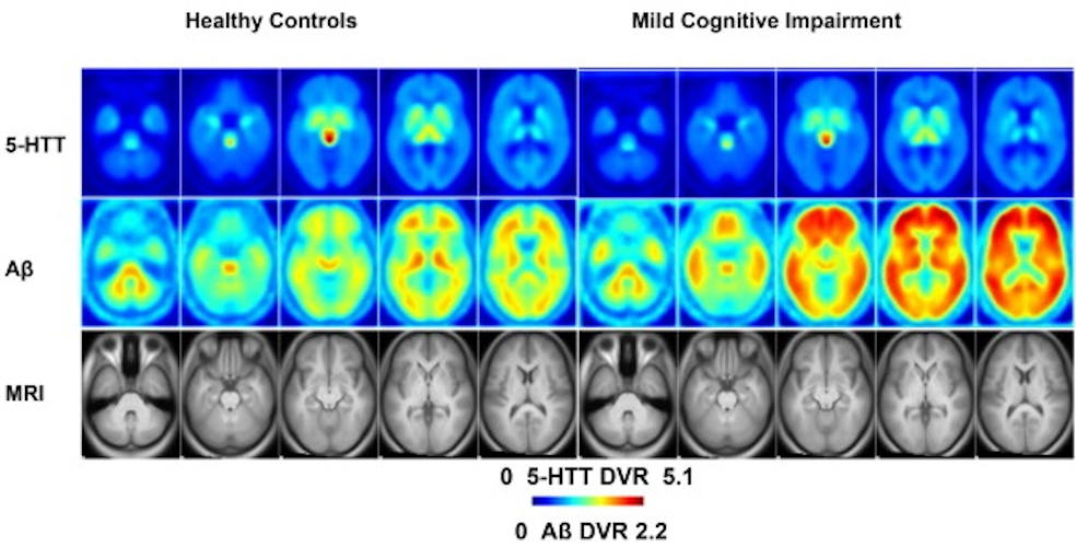 PET scans of 5-HTT and beta amyloid in healthy controls and individuals with MCI. Mean distribution volume ratio (DVR) images of healthy controls (left panels) and MCI (right panels) and an MRI template (bottom panel)