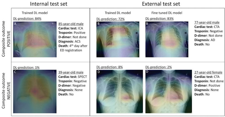 Gradient weighted class activation maps of representative chest radiographs