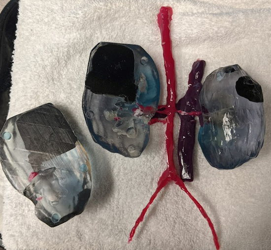 A 3D printed model depicts kidneys from a 32 month old boy with multiple Wilms tumors