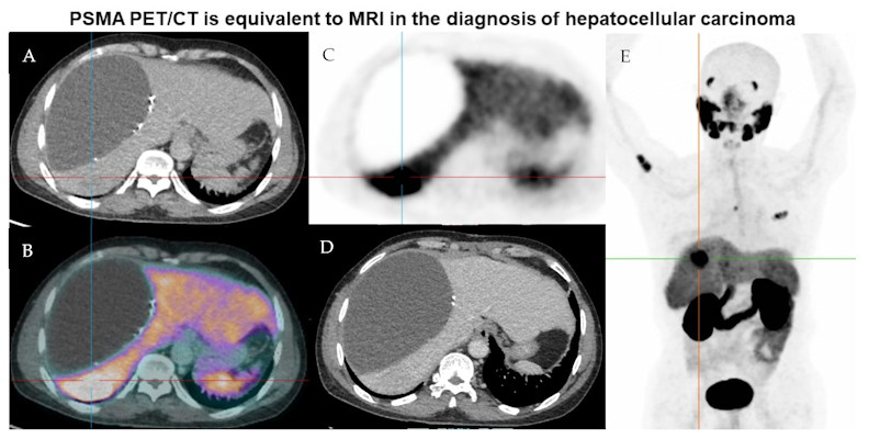 Representative imaging of a 58 year old male of Asian ethnicity with previous resection of HCC in 2019