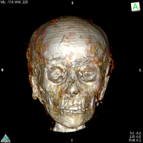 3D CT image shows oval face
