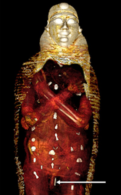 3D CT image of the front of the digitally unwrapped torso of mummy shows the crossed arms position and the amulets