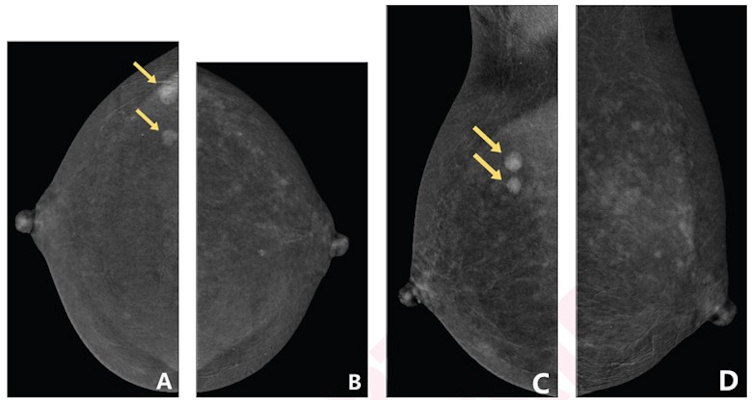 Contrast enhanced mammography images show that the degree of background parenchymal enhancement 