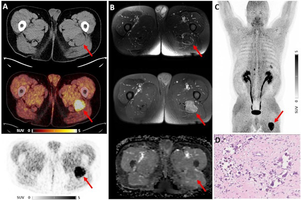 Ga 68 FAPI PET CT imaging in a 55 year old male patient