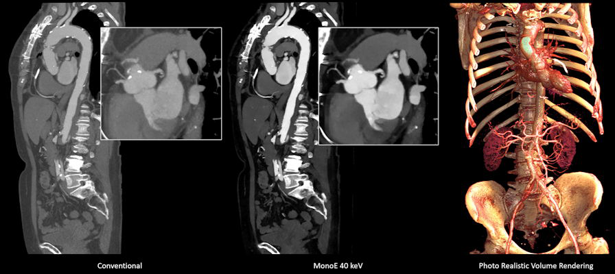 Chest, abdomen, and pelvis CT angiography performed in less than 2 seconds