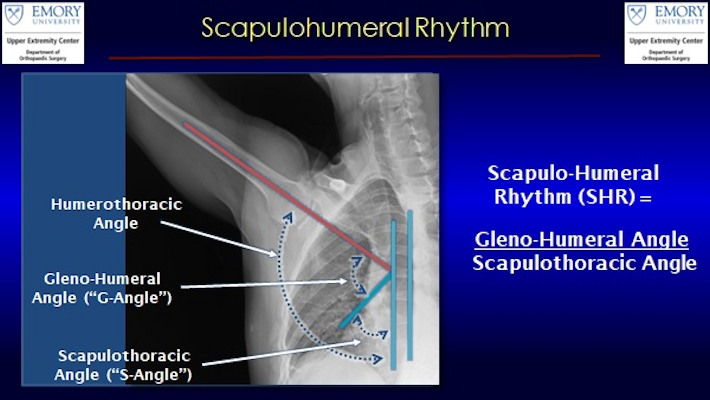 An x ray from dynamic digital radiography of the shoulder illustrates the angles used to measure the scapulohumeral rhythm in shoulders of patients with rotator cuff tears