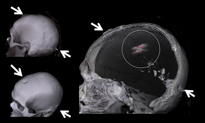 Gunshot injuries can be perfectly visualizised in 3D for court cases