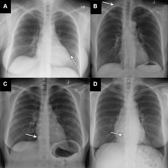 Four examples of x rays classified as abnormal, unremarkable by the reference standard but as normal by the AI tool