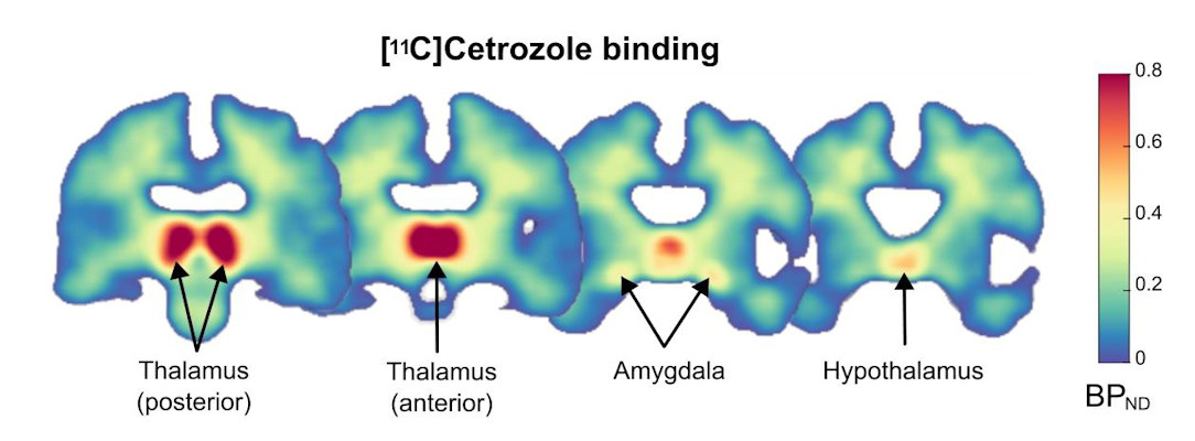 Distribution of C 11 cetrozole binding in the brain of healthy women