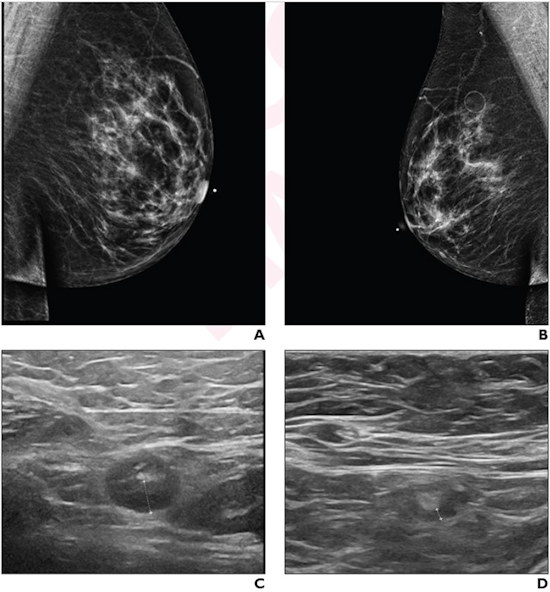 A 64 year old woman who underwent screening mammography and breast ultrasound presented with left axillary lymphadenopathy