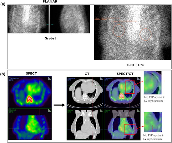 3 hour planar imaging interpreted as equivocal for ATTR amyloidosis