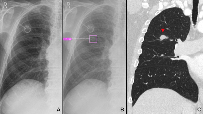 Example of a lung lesion detected by the AI Rad Companion Chest X-ray