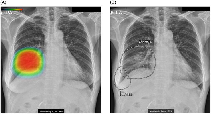 Chest radiographs of a 57 year old female with pneumonia and right pleural effusion