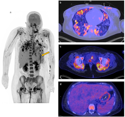 F 18 FDG PET/CT of a 26 year old woman with COVID 19