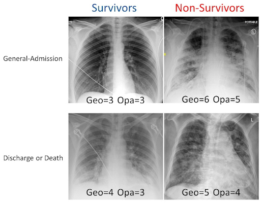 Examples of chest x rays with different geographic extent and opacity scores
