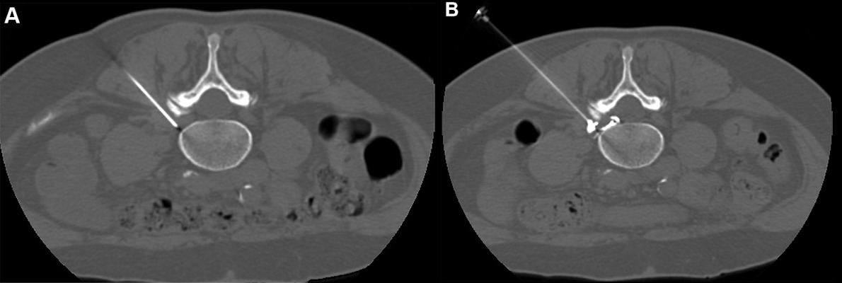 CT guided pulsed radiofrequency with transforaminal epidural steroid injection