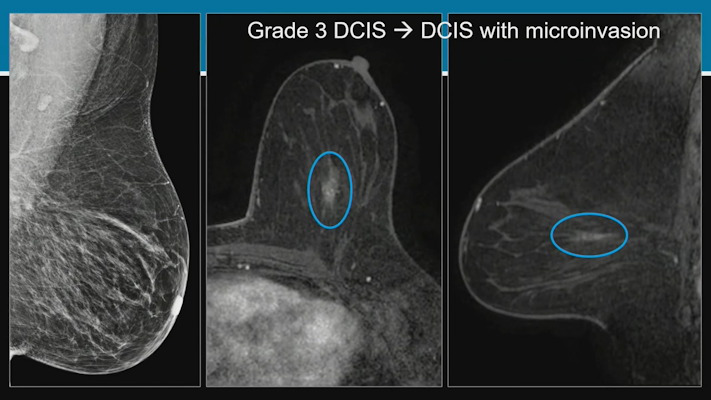 Researchers at the ARRS annual meeting described false negative rates and characteristics on screening digital breast tomosynthesis