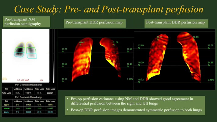 Padma Manapragada of the University of Alabama Birmingham presented a study of the use of dynamic digital radiography in preoperative lung transplant patients at ARRS 2023 in Honolulu
