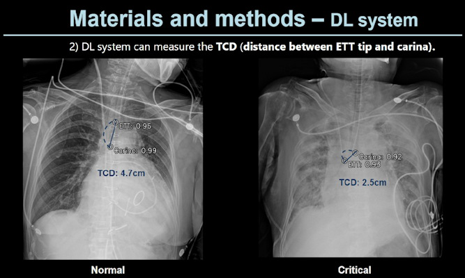 A slide presented by researchers at the ARRS meeting in Hawaii showed measurements used by an AI model for detecting correct endotracheal tube placements in x-rays of ICU patients