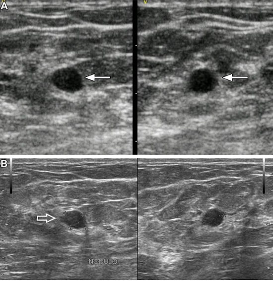 Images of a 37 year old woman show a palpable mass due to low grade ductal carcinoma in situ