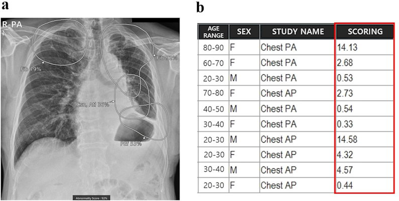 Integration of AI for chest x-rays on PACS