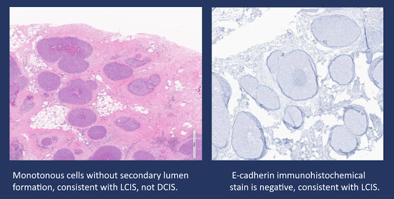 Pleomorphic lobular carcinoma in situ and ductal carcinoma in situ may be confused from each other as was the original pathology interpretation in this case of a 50 year old woman presenting with suspicious imaging findings on DBT and subsequent ultrasound