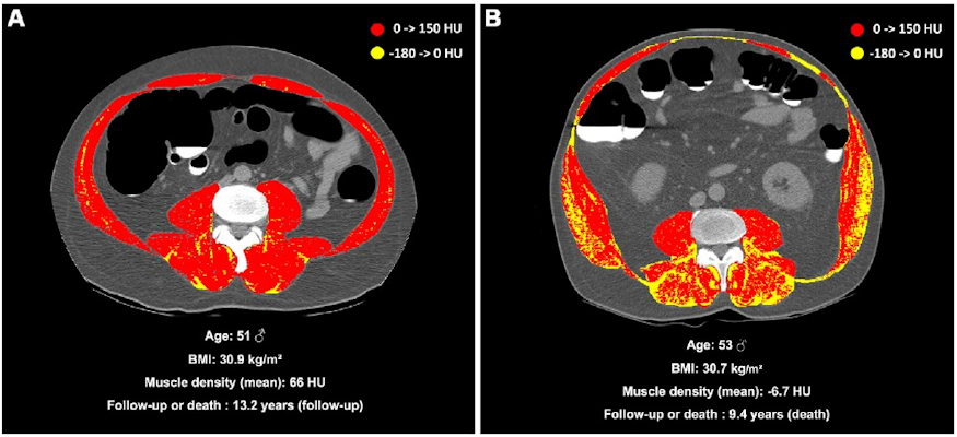 Unenhanced axial abdominal CT image with a Hounsfield unit based color scale of skeletal muscles in a 51 year old man shows mild fatty infiltration in the muscles