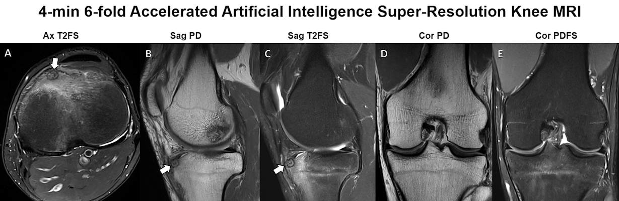 Knee MRI in a 30 year old man with knee pain