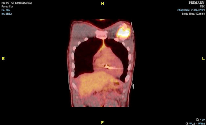 A PET CT image demonstrating evidence of increased FDG activity posterior to the cardiac conduction device along the anterior left