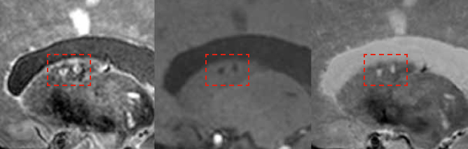7-tesla MRI can detect the total burden of larger and smaller infarcts, including small microinfarcts in the deep gray matter