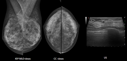 Normal mammographic views, but ultrasound detects a 5-mm invasive ductal carcinoma