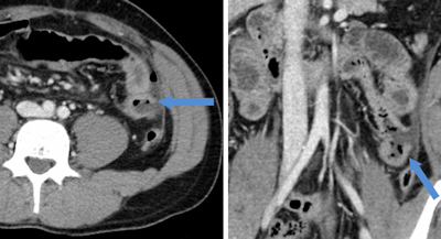 Images show traumatic rupture of the bowel