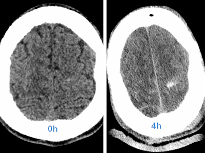 CT head scan with increasing visibility of intracranial hemorrhage in the first few hours