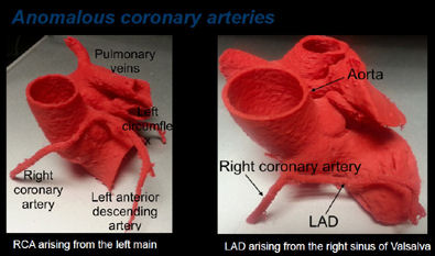 anomalous coronary arteries