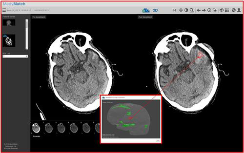 Screen shot of MedyMatch analysis of head CT