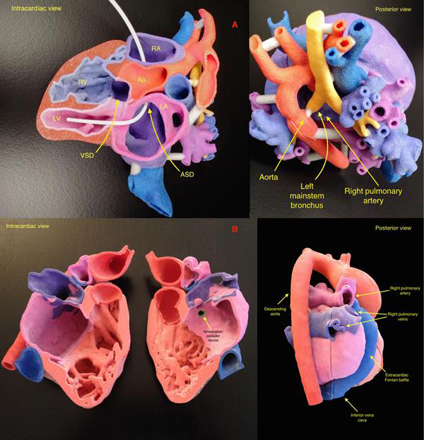 Multicolor 3D-printed heart