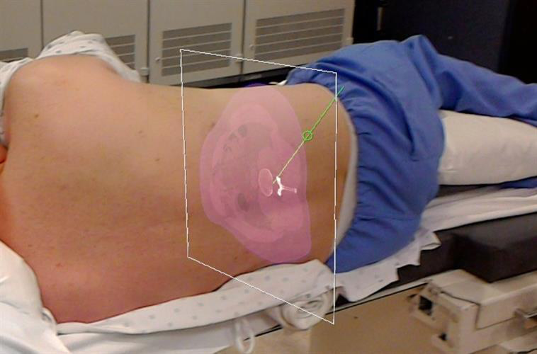 Person with scan and planned trajectory for needle insertion overlaid on his back