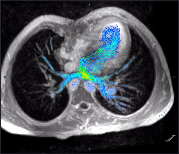 4D flow MRI, 3D printing improve congenital heart surgery