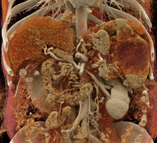 Cinematic rendering of an abdominal CT scan