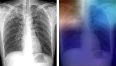 Left chest radiograph shows upper lobe opacities with pathologic analysis-proven active TB, while right has a heat map overlay