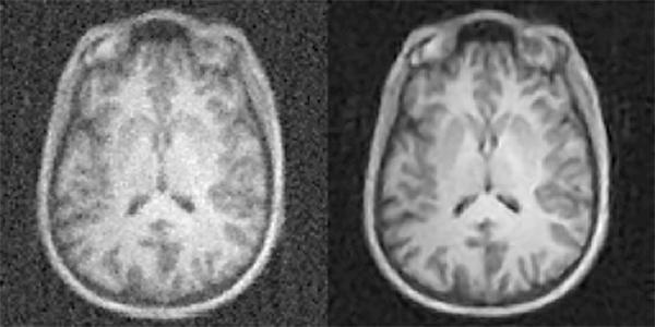 Brain images without and with AUTOMAP