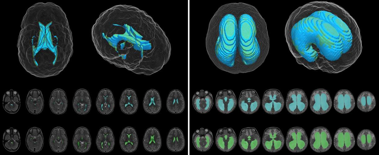 Deep-learning model (blue) and ground-truth manual (green) segmentation of representative control (left) and hydrocephalus (right) T2-weighted MR images.