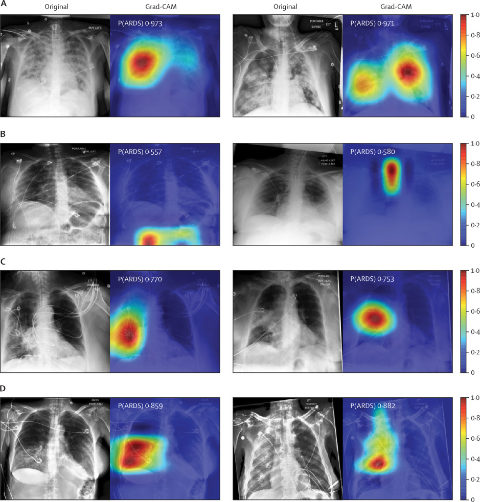 Chest radiographs were grouped based on CNN probabilities of ARDS and physician ARDS annotations; gradient-weighted class activation mapping (Grad-CAM) was then used to localize areas used by the CNN to identify ARDS within the radiographs