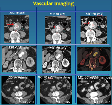 Low-kV imaging improves vascular imaging
