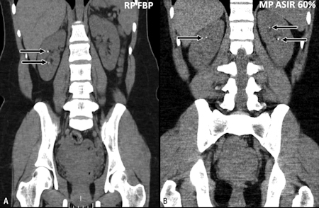 Coronal CT in 28-year-old with renal stones