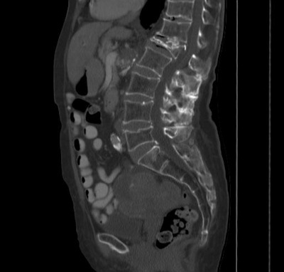 Low attenuation in the L2 vertebra was used to diagnose osteoporosis at CT in patient with compression fracture